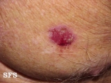 basal cell carcinoma