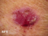 basal cell carcinoma
