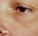basal cell carcinoma