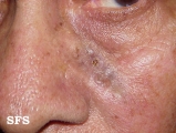 basal cell carcinoma