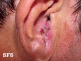 basal cell carcinoma
