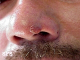 basal cell carcinoma