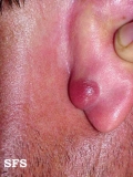 basal cell carcinoma