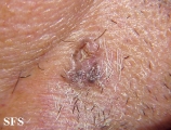 basal cell carcinoma