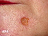 basal cell carcinoma