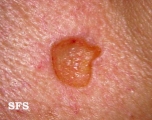 basal cell carcinoma