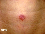 basal cell carcinoma