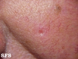basal cell carcinoma