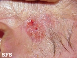 basal cell carcinoma
