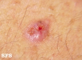 basal cell carcinoma