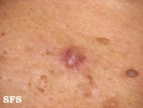 basal cell carcinoma