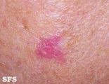 basal cell carcinoma