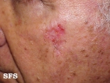 basal cell carcinoma