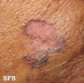 basal cell carcinoma