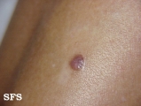 basal cell carcinoma