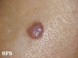 basal cell carcinoma