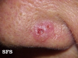 basal cell carcinoma