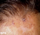 basal cell carcinoma
