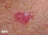 basal cell carcinoma