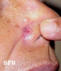 basal cell carcinoma