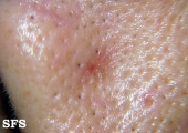 basal cell carcinoma