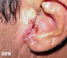 basal cell carcinoma