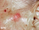 basal cell carcinoma