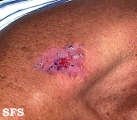 basal cell carcinoma