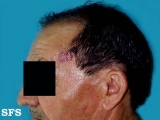 basal cell carcinoma