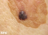 basal cell carcinoma
