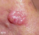 basal cell carcinoma