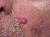 basal cell carcinoma