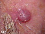 basal cell carcinoma