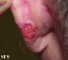 basal cell carcinoma