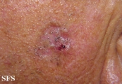 basal cell carcinoma