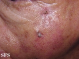 basal cell carcinoma