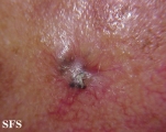 basal cell carcinoma