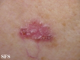 basal cell carcinoma