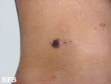 basal cell carcinoma