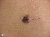 basal cell carcinoma
