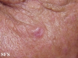 basal cell carcinoma