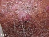 basal cell carcinoma