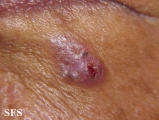 basal cell carcinoma