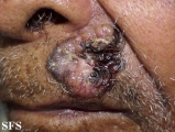 basal cell carcinoma