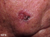 basal cell carcinoma
