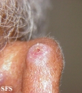 basal cell carcinoma