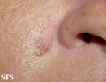 basal cell carcinoma