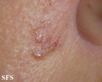 basal cell carcinoma