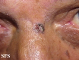 basal cell carcinoma