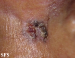basal cell carcinoma